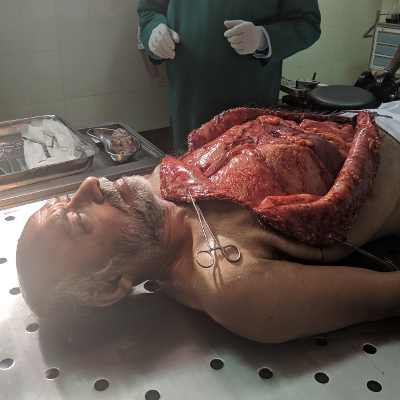 Autopsy Prosthetic