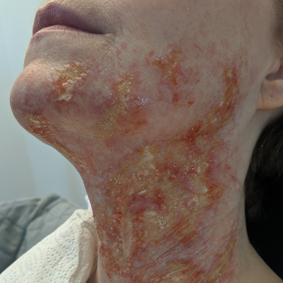 Complex Acid Burn