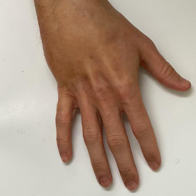 Holby City Metacarpal Fracture Onset